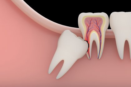 Wisdom Tooth Removal in Pimple Saudagar