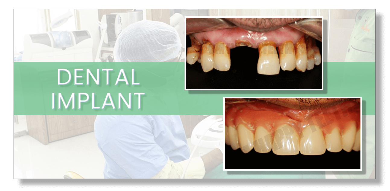 Dental Implants in Pimple Saudagar, Hinjewadi