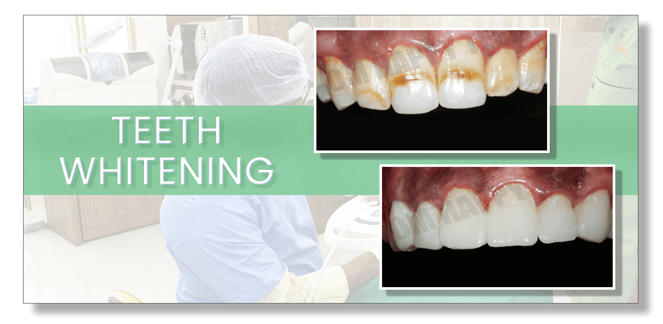 Teeth Whitening in Pimple Saudagar, Hinjewadi