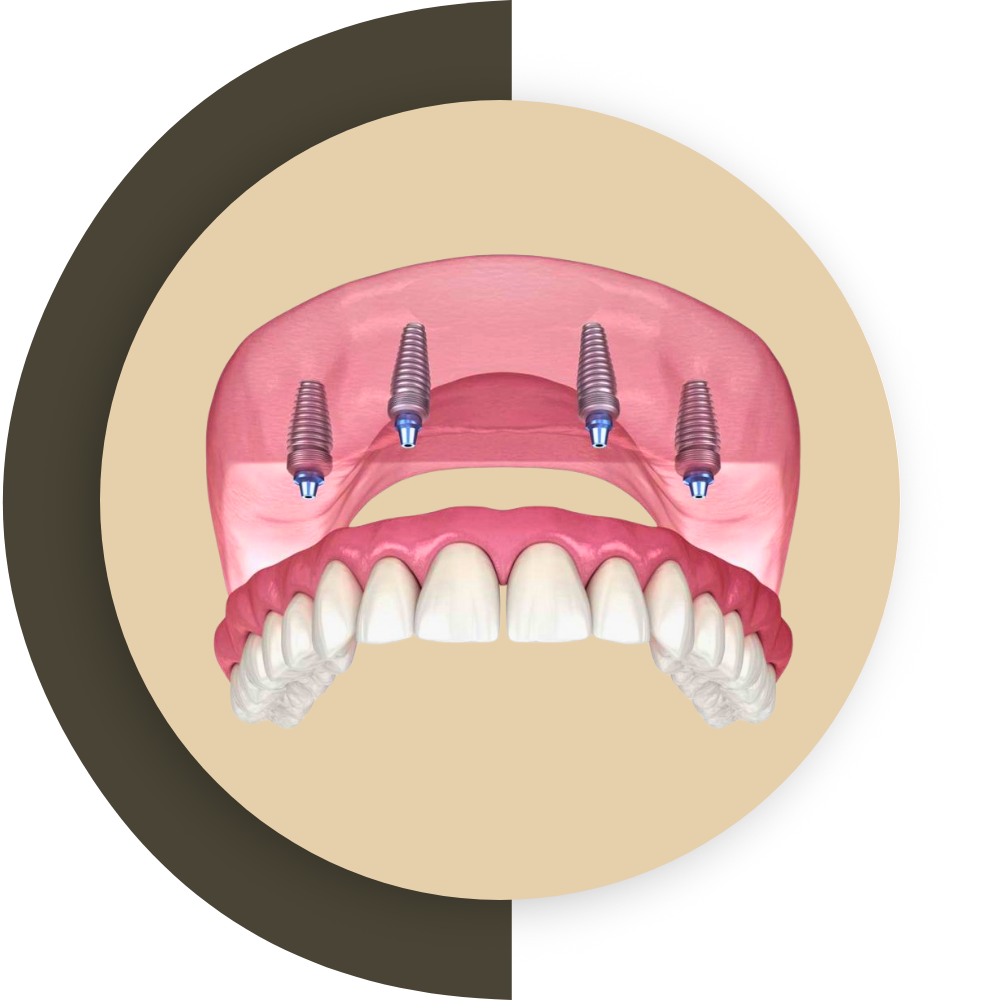 All On 4 Dental Implants