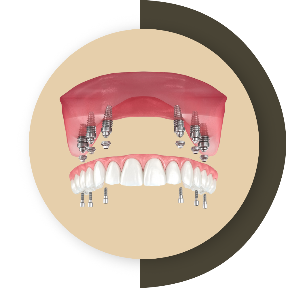 All On 6 Implant