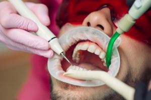 teeth cleaning in pimple saudagar