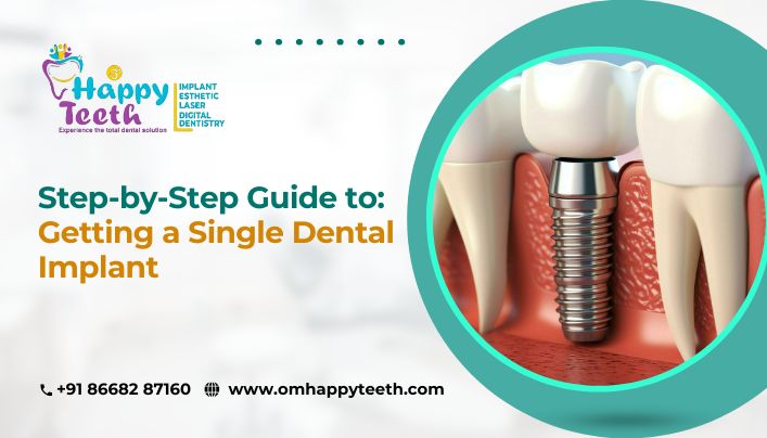 Step-by-Step Guide to Getting a Single Dental Implant