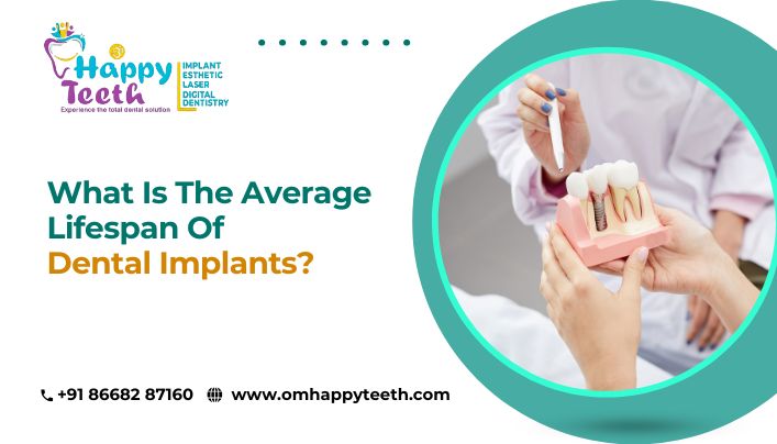 What Is the Average Lifespan of Dental Implants?