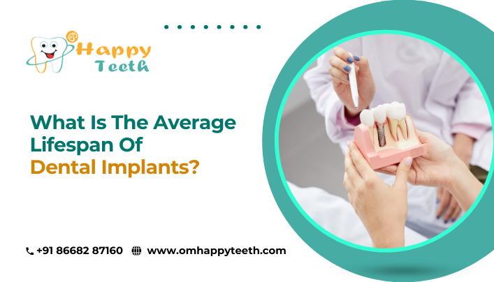 What Is the Average Lifespan of Dental Implants?