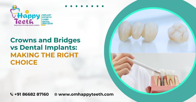 Crowns And Bridges Vs Dental Implants: Making The Right Choice