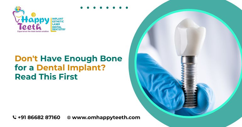 Don’t Have Enough Bone for a Dental Implant? Read This First