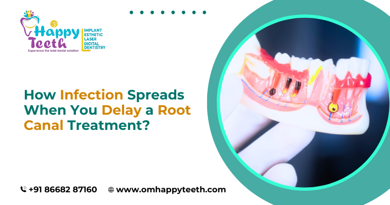 How Infection Spreads When You Delay a Root Canal Treatment?