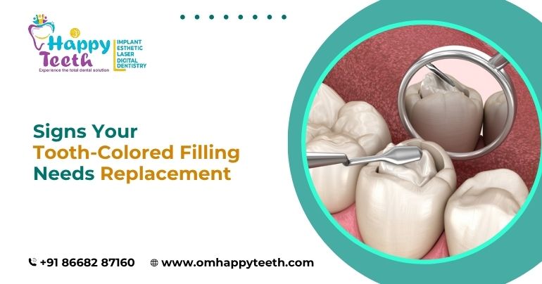 Signs Your Tooth Colored Filling Needs Replacement